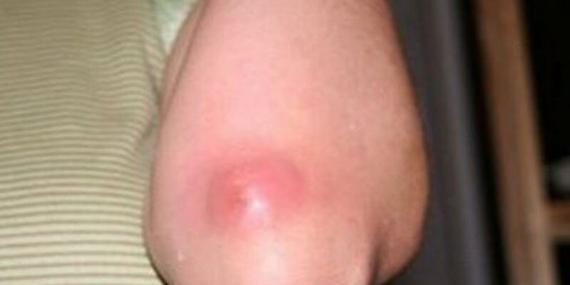 What Are the Symptoms of Boils?