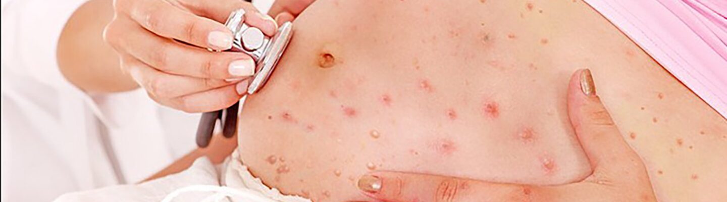 Chickenpox During Pregnancy: Can It Affect the Baby?