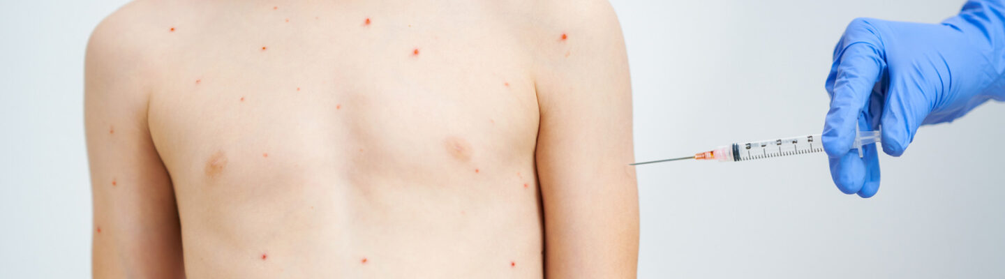 Can People with Measles Use an Electric Fan?