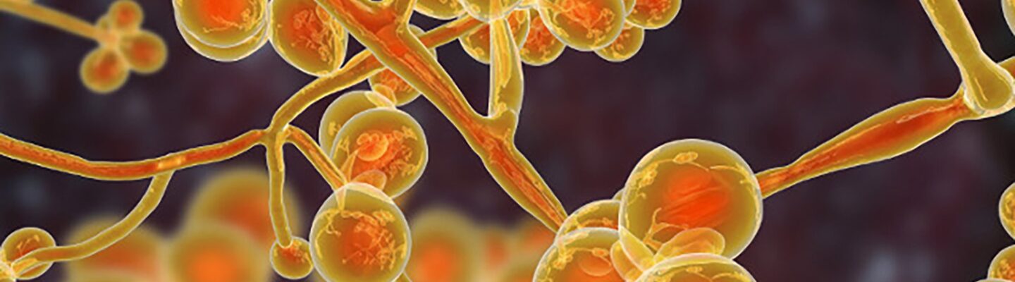 How Do I Prevent Tinea Versicolor?