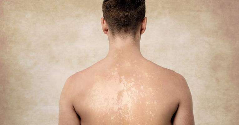 How to Tell if You Have Tinea Versicolor