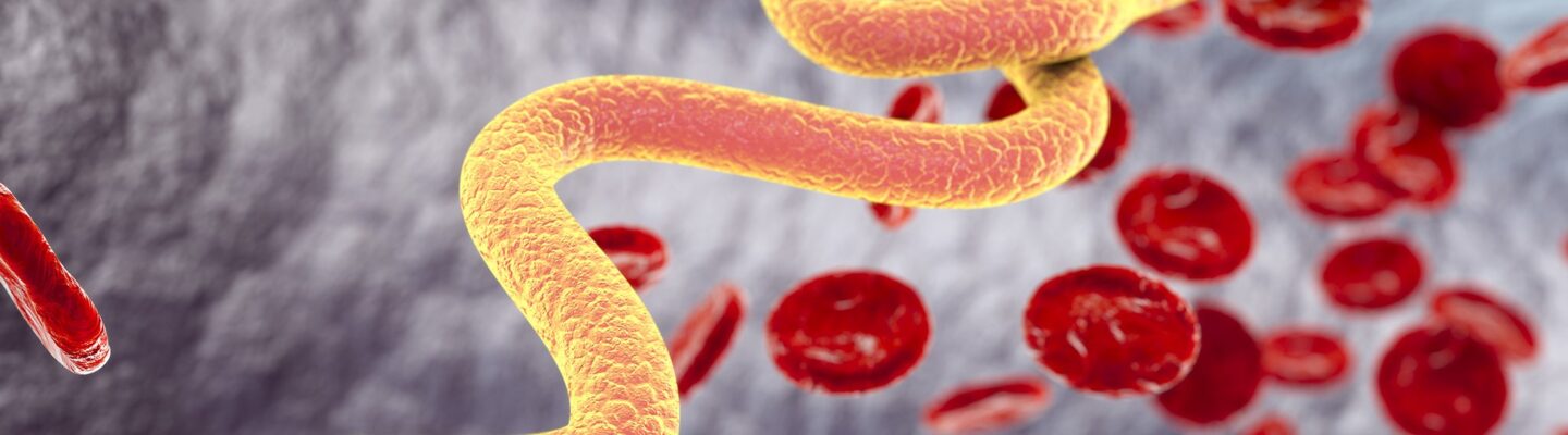 What Are the Symptoms of Filariasis or Elephantiasis?