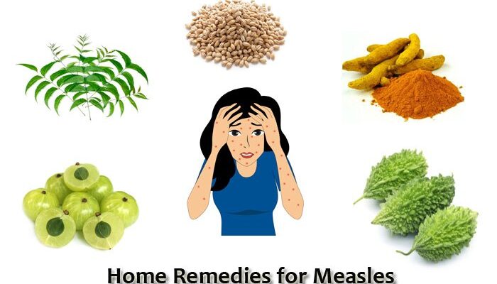 How to Prevent Measles (Tigdas)