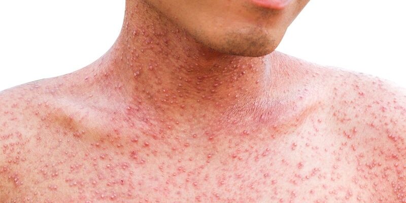 What is the Treatment for Measles?