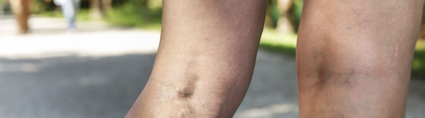 Varicose Veins: Causes, Symptoms, and Treatments