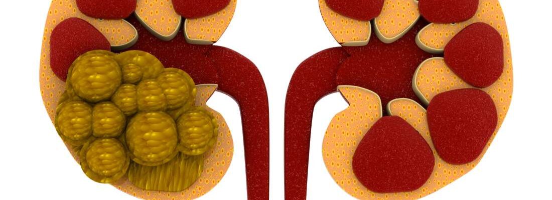 Kidney Stones
