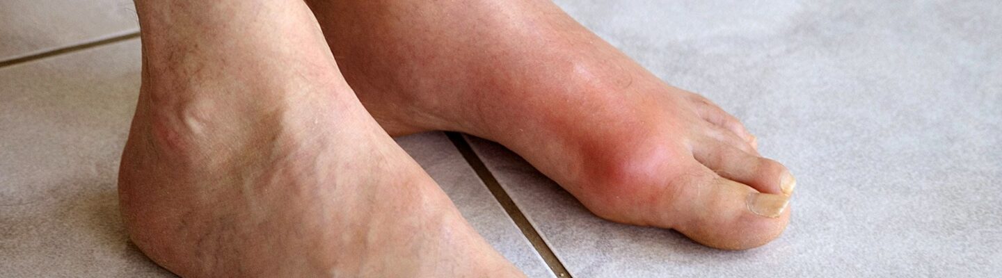High Uric Acid