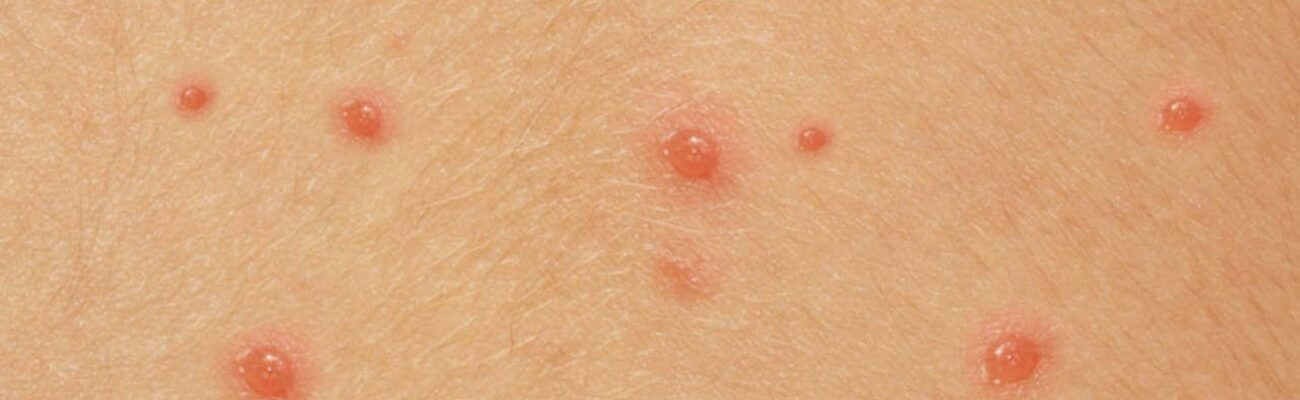 Chickenpox