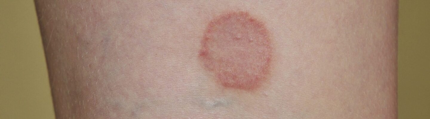 Ringworm