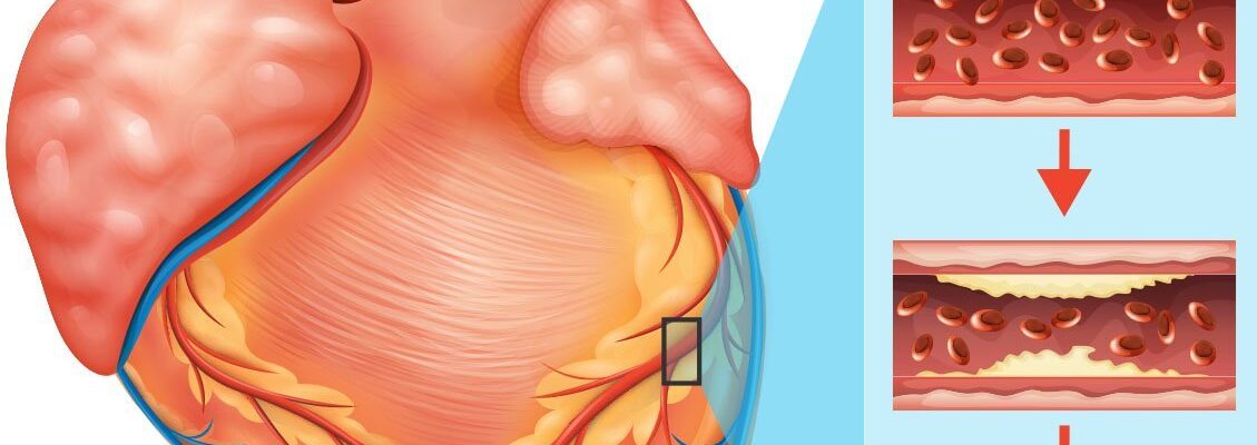 Coronary Artery Disease
