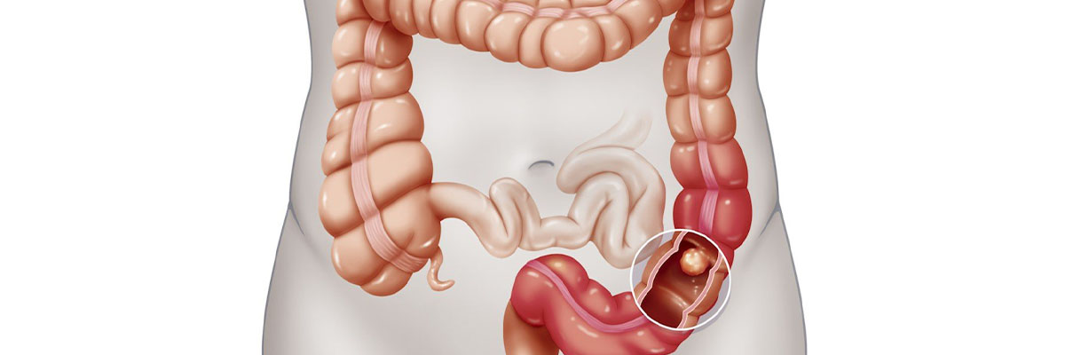 Colon Cancer
