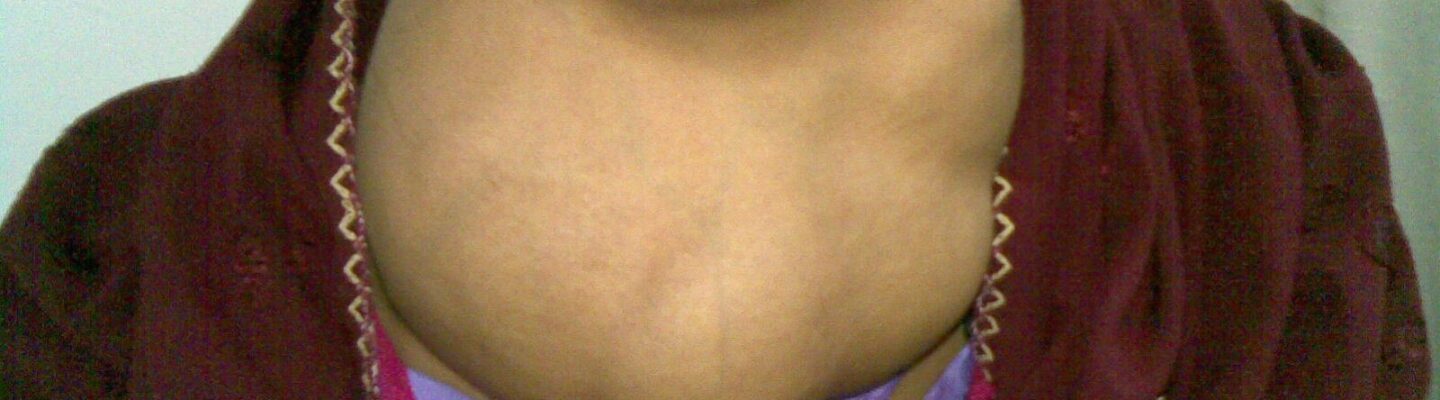 Goiter