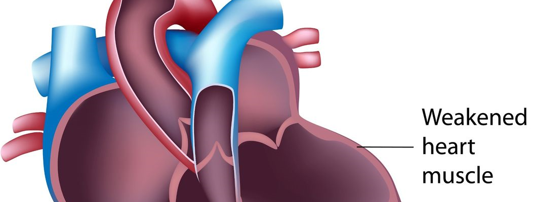 Dilated Cardiomyopathy