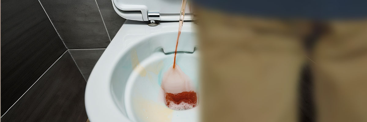 Hematuria