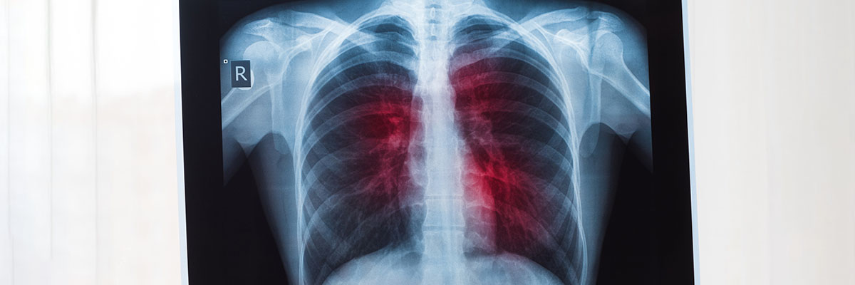 Lung Cancer