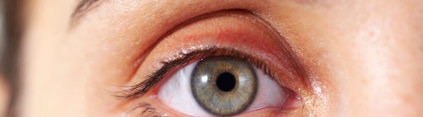 Glaucoma