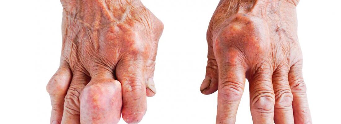 Gout