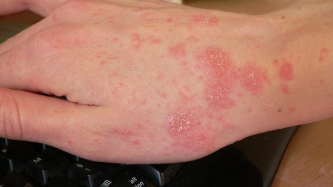 Scabies