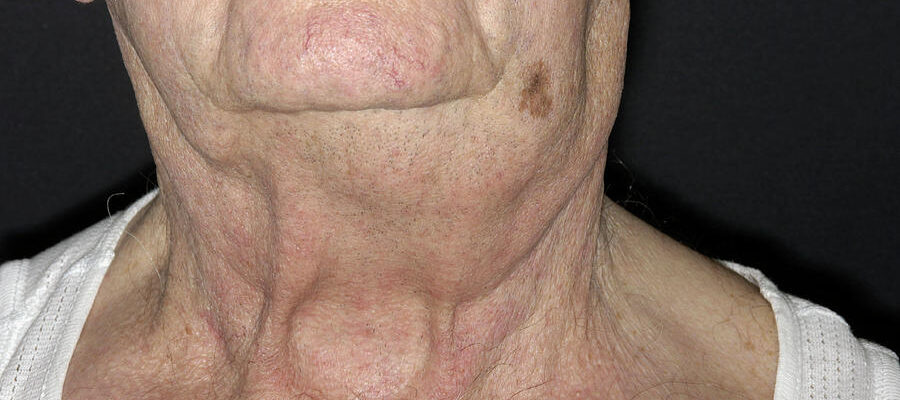Lymphoma