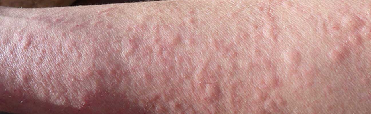 Allergy