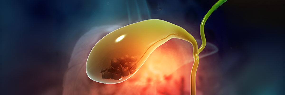 Gallstones