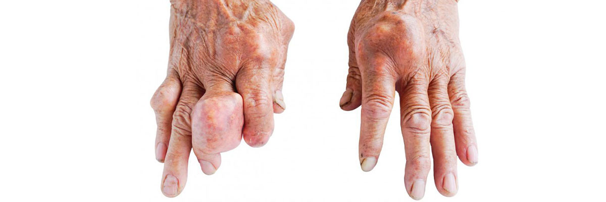 Gout