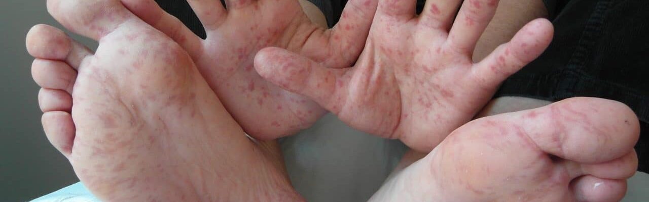 Reye’s Syndrome