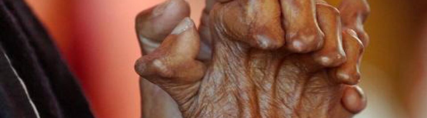 Leprosy