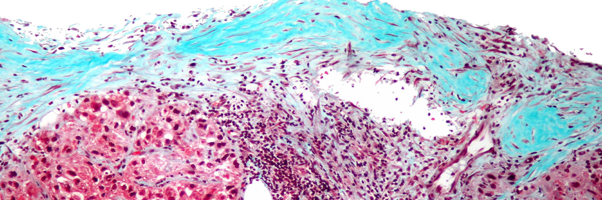 Liver Cancer