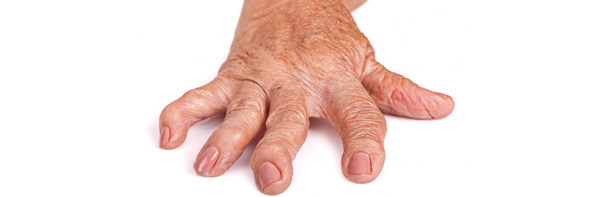 Rheumatoid Arthritis
