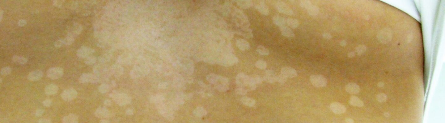 Tinea Versicolor
