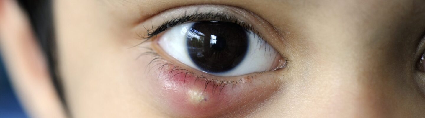 Chalazion
