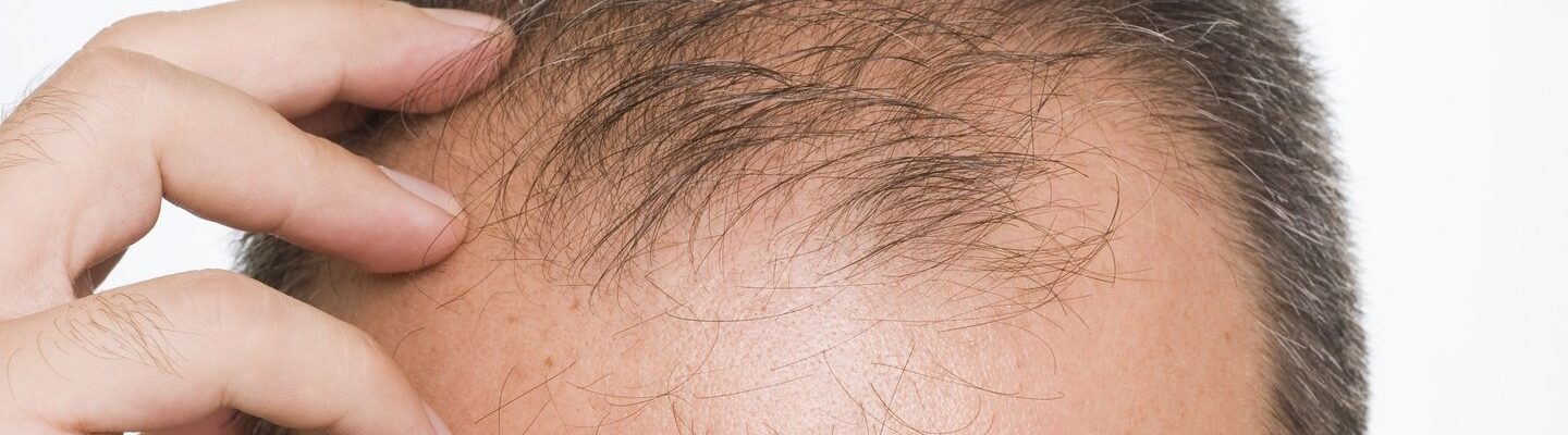 Baldness In Men: What You Need to Know