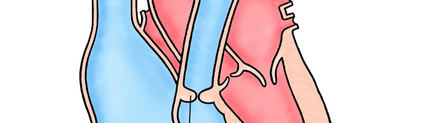 Pulmonary Stenosis