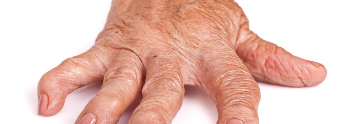 Rheumatoid Arthritis