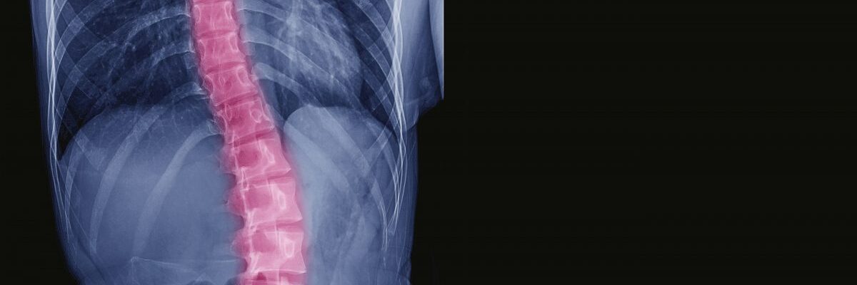 Scoliosis