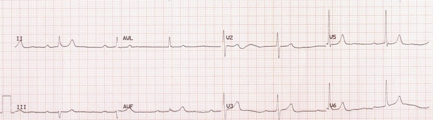 Atrioventricular Block (Heart Block)