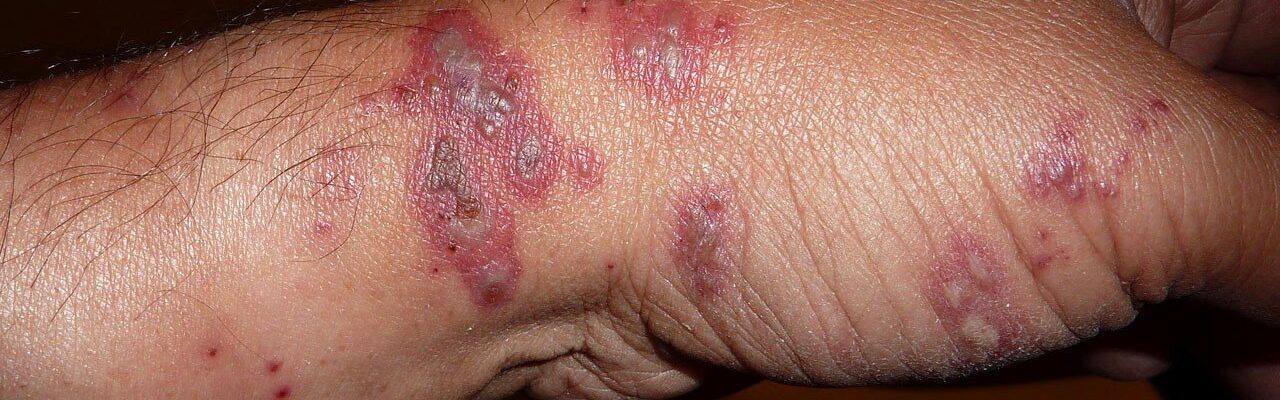 Bubonic Plague (Black Death)