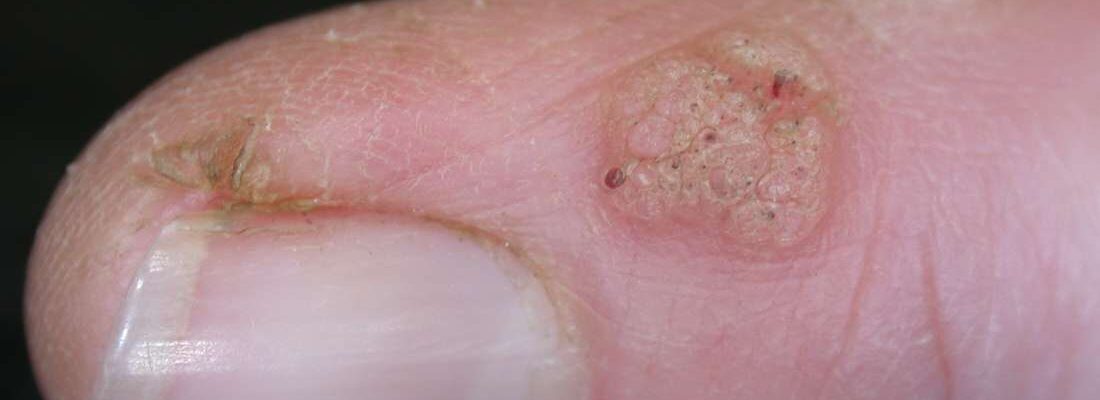 Warts