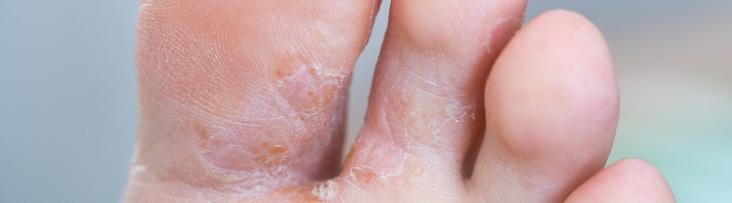 Athlete’s Foot