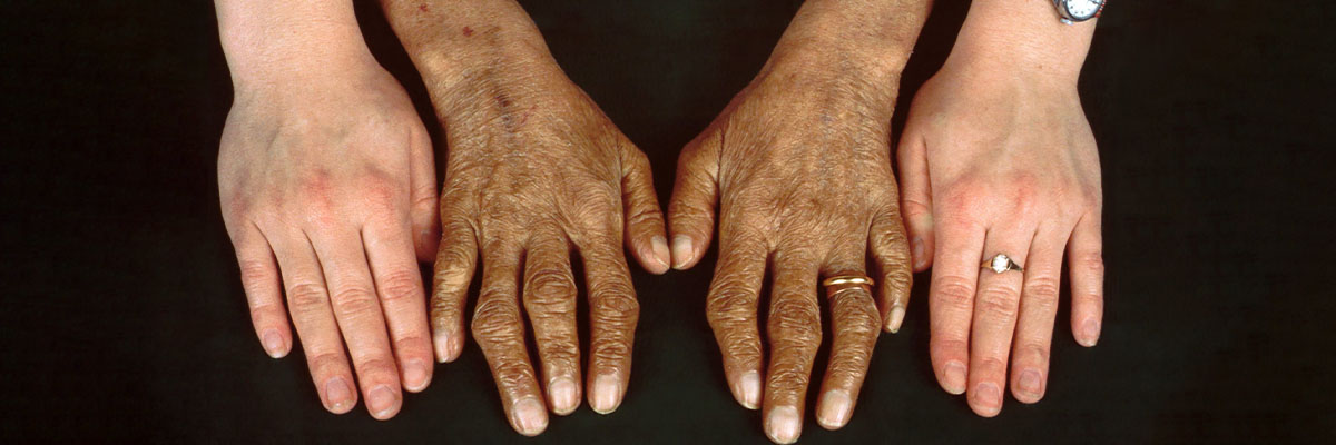 Hemochromatosis