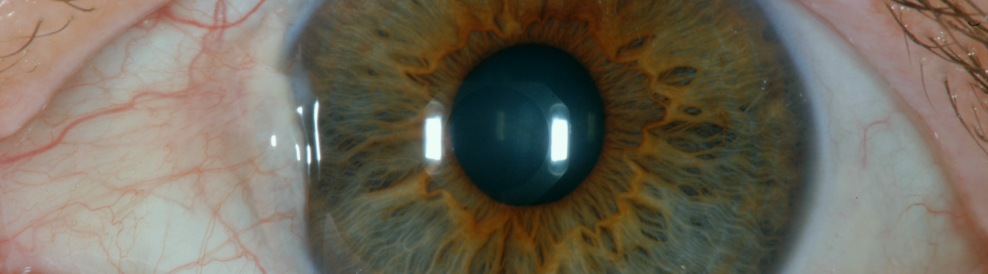 Pterygium