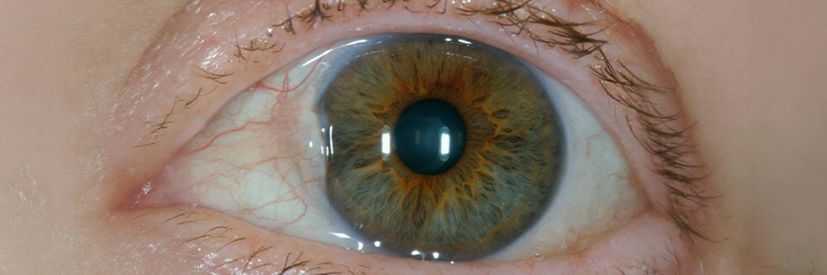 Pterygium