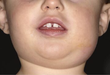 child with mumps