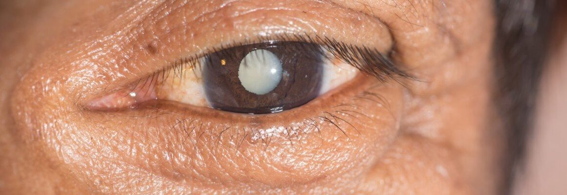 Cataracts (Katarata)