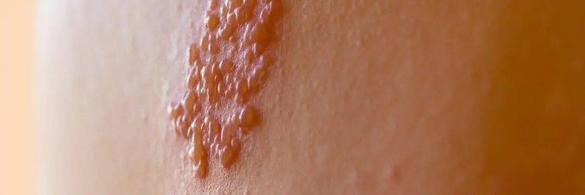 Herpes