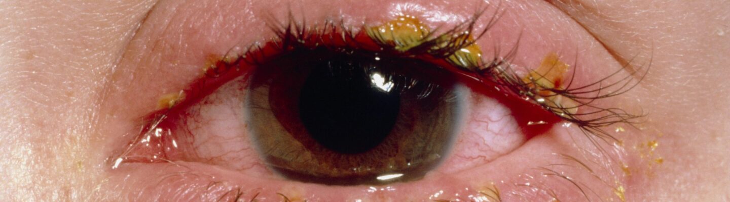 Blepharitis