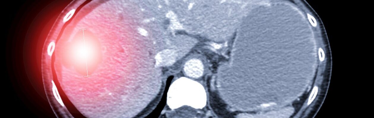 Liver Cyst (Cyst sa Atay)