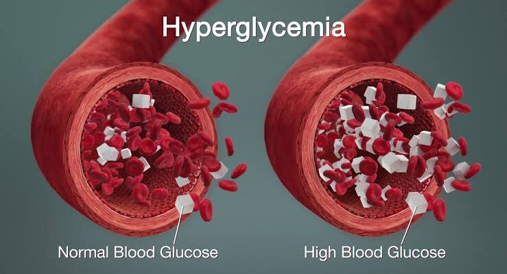 Hyperglycemia