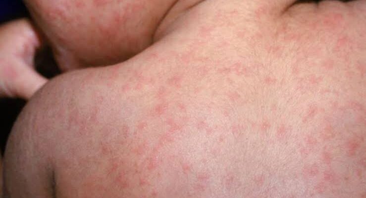 Measles